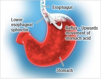 Illustration of stomach and Causes of Acid Reflux & Heartburn